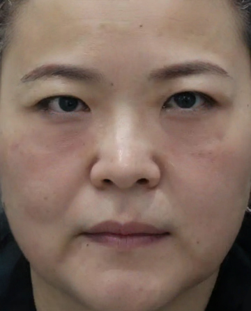 去眼袋手术