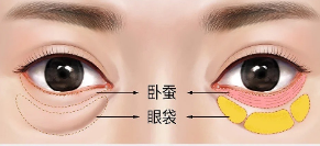 去眼袋手术