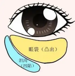 去眼袋手术