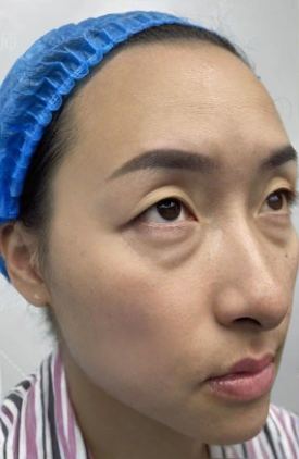 去眼袋手术