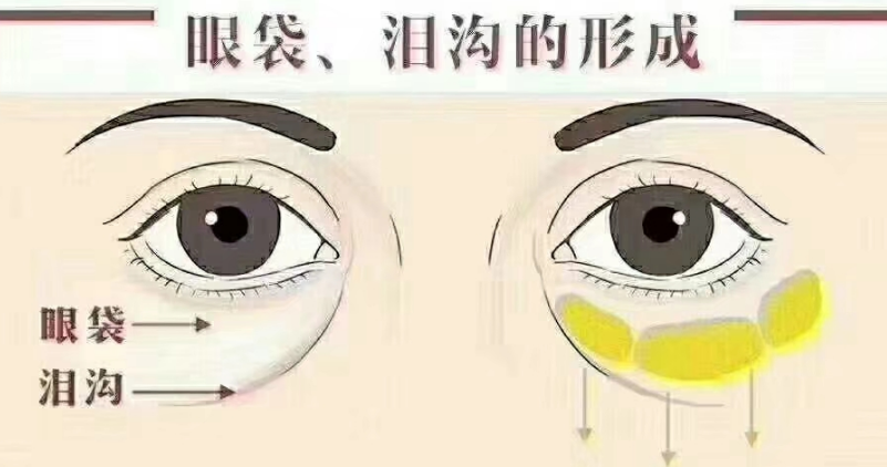 去眼袋手术