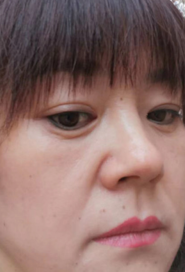 去眼袋手术
