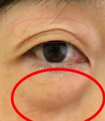 去眼袋手术