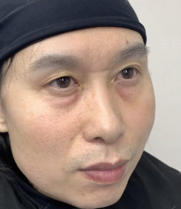 去眼袋手术
