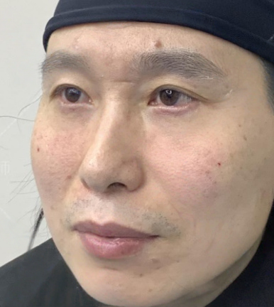 去眼袋手术