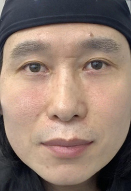 去眼袋手术