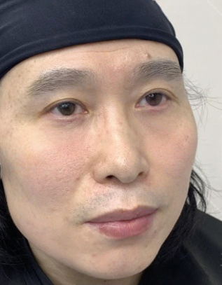 去眼袋手术