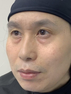 去眼袋手术