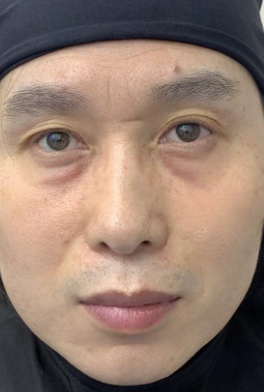 去眼袋手术