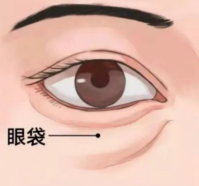 眼袋