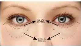 眼袋