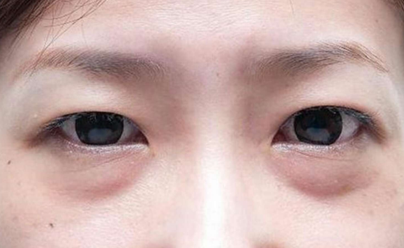 眼袋