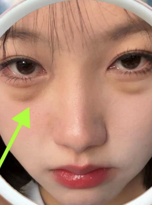 眼袋