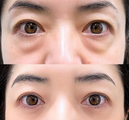 眼袋
