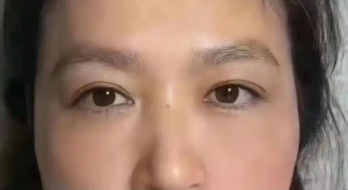 眼袋