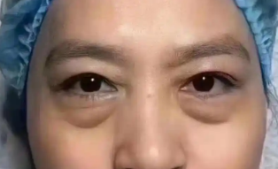 眼袋