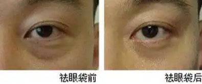 眼袋