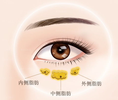 眼袋