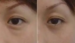 眼袋