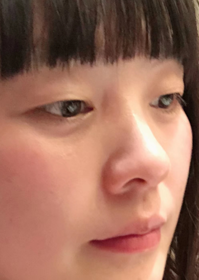去眼袋手术