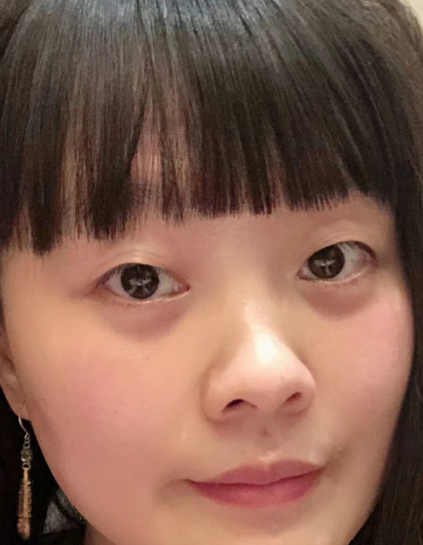 去眼袋手术
