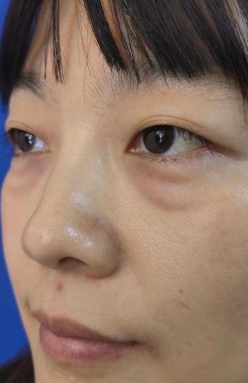 去眼袋手术