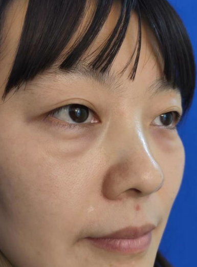 去眼袋手术