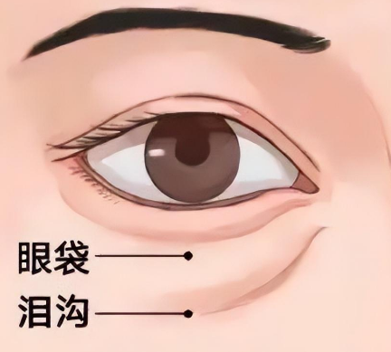 去眼袋手术