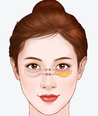 去眼袋手术