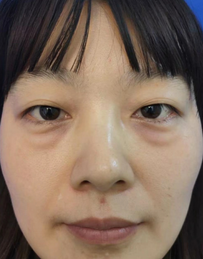 去眼袋手术