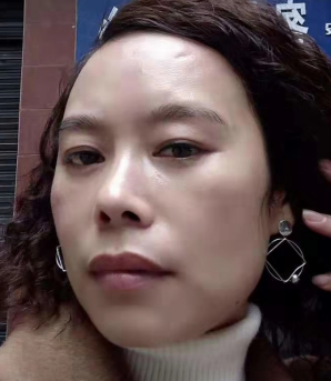 去眼袋手术