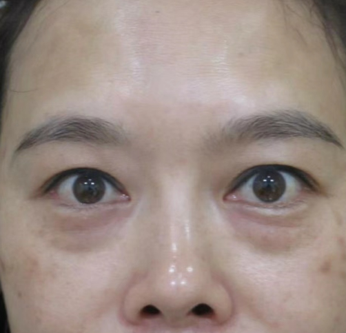 去眼袋手术