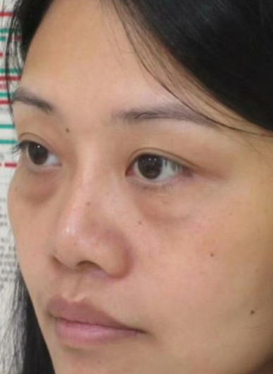 去眼袋手术