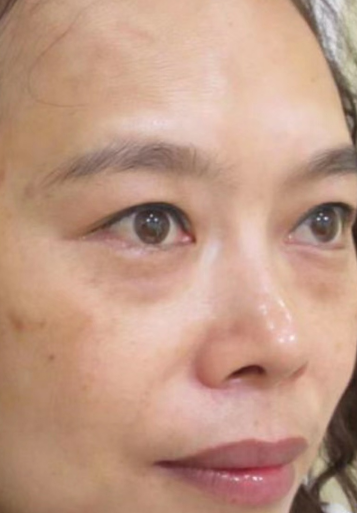 去眼袋手术