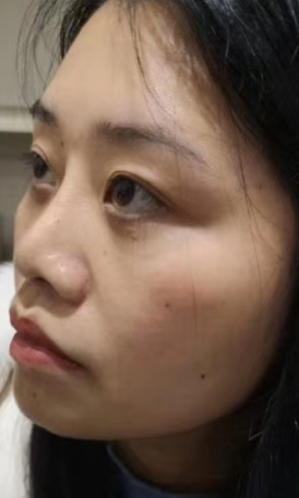 去眼袋手术