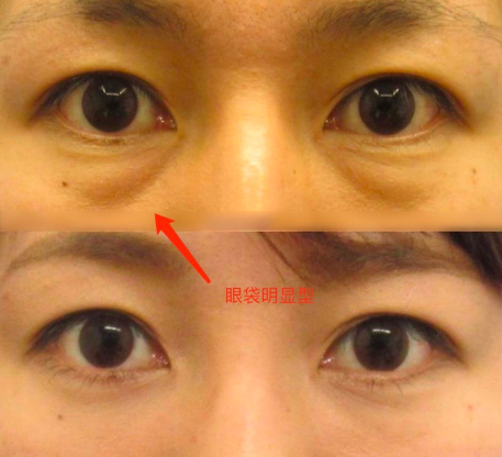 去眼袋手术