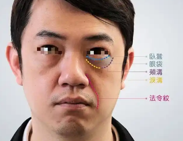 去眼袋手术
