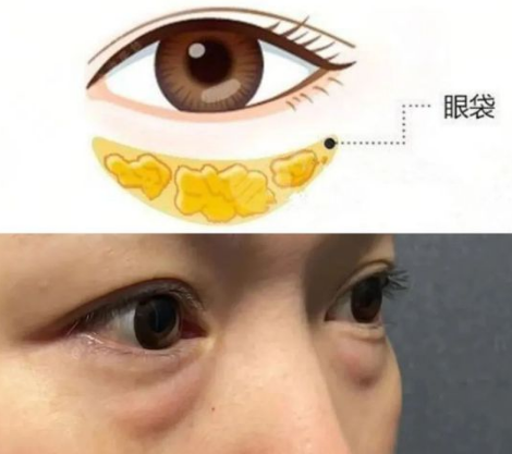 去眼袋手术