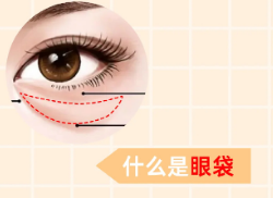 去眼袋手术