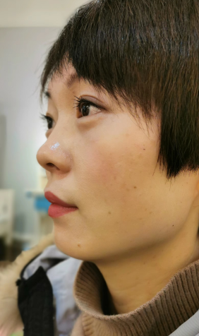 去眼袋手术