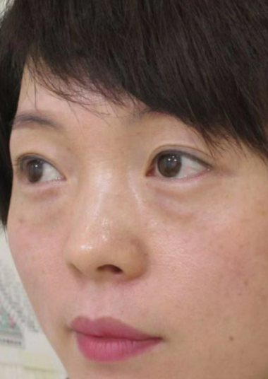 去眼袋手术