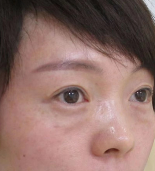 去眼袋手术