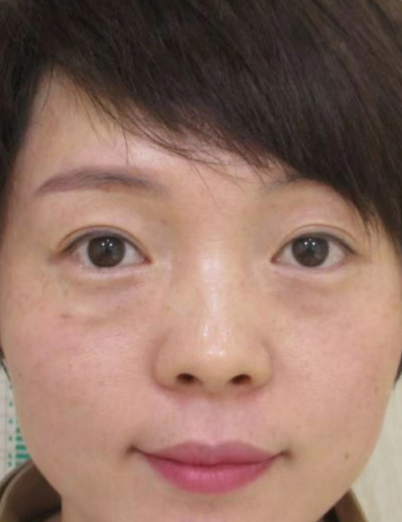 去眼袋手术