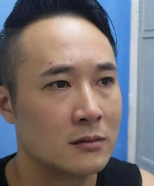 去眼袋手术
