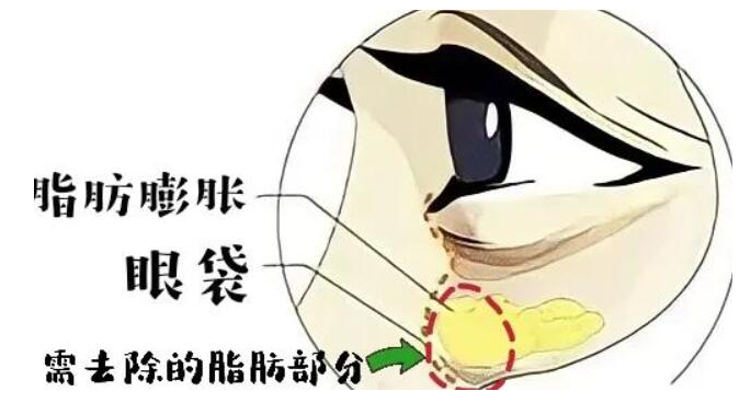 去眼袋手术