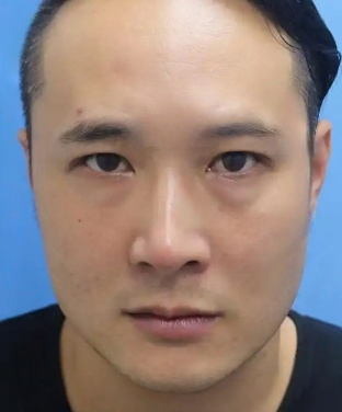 去眼袋手术