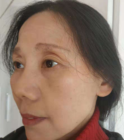 去眼袋手术