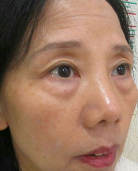去眼袋手术