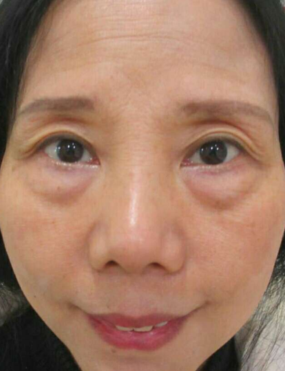 去眼袋手术