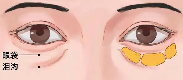 去眼袋手术